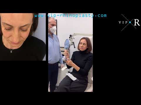 First spontaneous reaction to natural rhinoplasty result 👩 6 days after nose job surgery