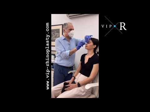 Nose Splint Removal 6 days after Surgery| The No Packing Rhinoplasty |Αφαίρεση Νάρθηκα