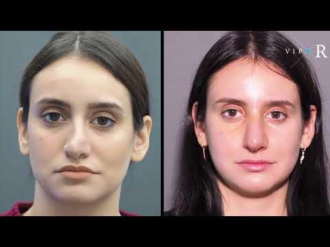 Georgia A| Revision Rhinoplasty Result Experience✌️ | Before &amp; After Nose job in 180ᵒ view 🎥