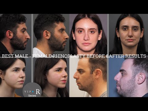 Rhinoplasty Before &amp; After Photos Compilation📷 Male &amp; Female nose job 6d post-op Ρινοπλαστική Φωτό