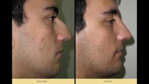 rhinoplasty: photo of a man after nose surgery