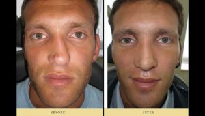 rhinoplasty : man after nose surgery