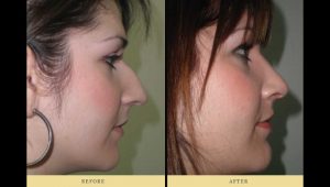 rhinoplasty : woman profile after nose surgery