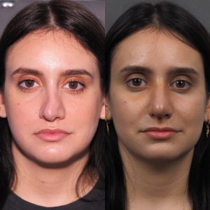 apotyximeni rinoplastiki diorthosi me epanepemvasi