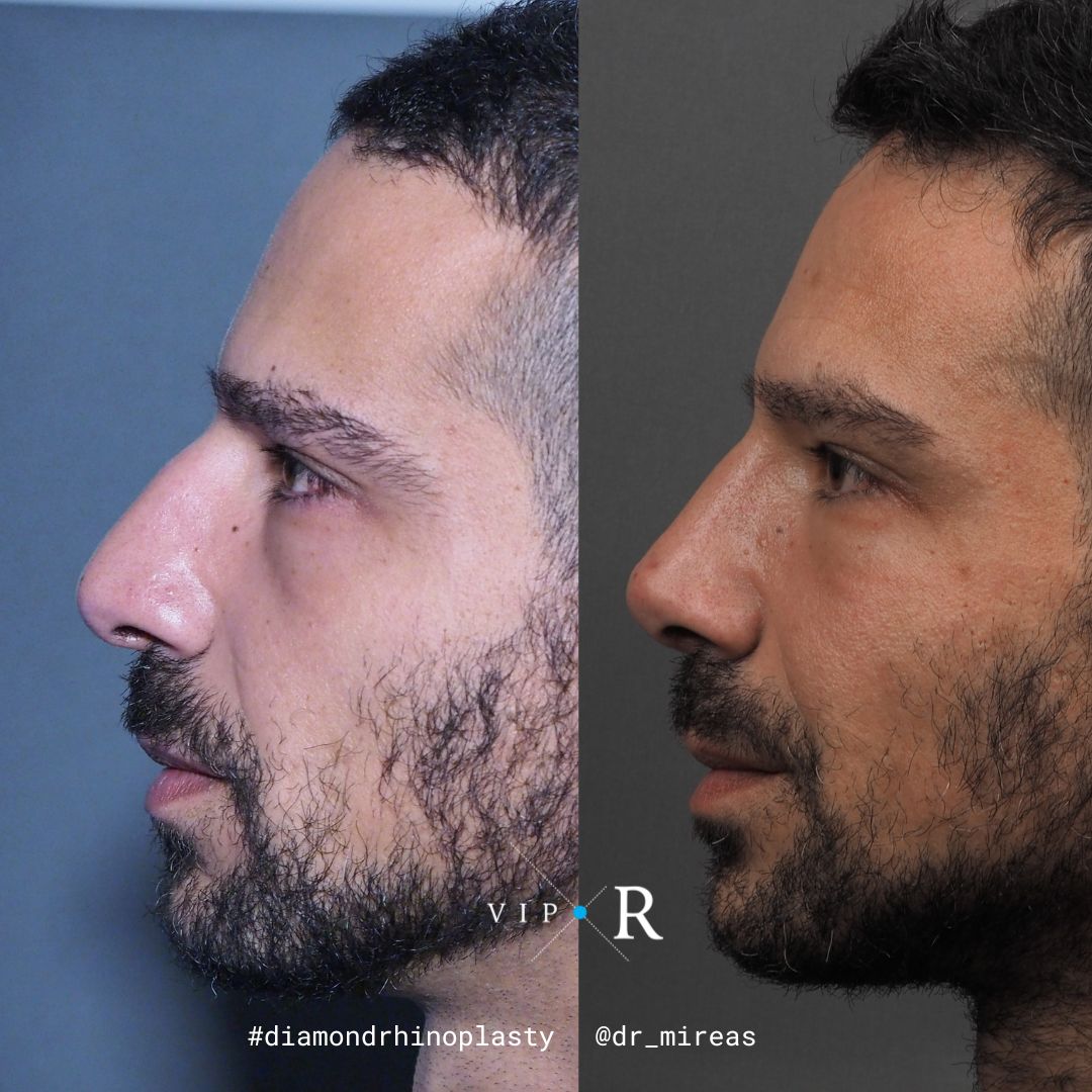 Ρινοπλαστική Φωτογραφίες & βίντεο ασθενών πριν και μετά τη ρινοπλαστική με υπερήχους piezo με τον Δρ Μοιρέα από 6 ημέρες έως και χρόνια μετά.   ρινοπλαστική φωτογραφίες πριν και μετά την πλαστική στη μύτη Δρ. Μοιρέας Αθήνα ρινοπλαστική στους άνδρες