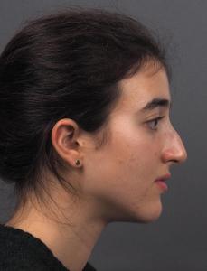01a. Pre-op Rhinoplasty Before and After photos 01498