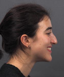 02a. Pre-op Rhinoplasty Before and After photos 01498