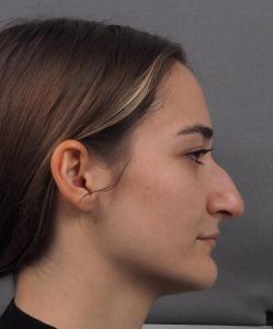 02a. Pre-op Rhinoplasty Before and After photos 01771