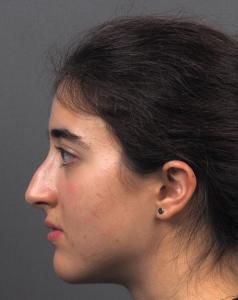 03a. Pre-op Rhinoplasty Before and After photos 01498