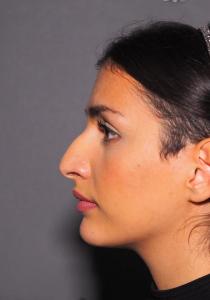 04a. Pre-op Rhinoplasty Before and After photos 01397