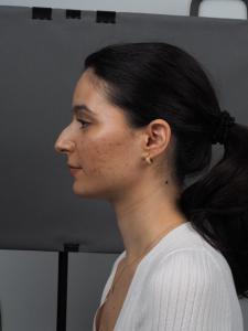 04a. Pre-op Rhinoplasty Before and After photos 01542