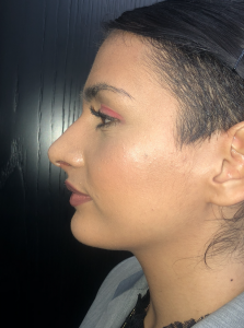 04b. Post-op Rhinoplasty Before and After photos 01397