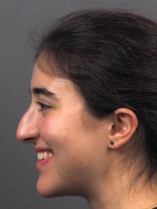 05a. Pre-op Rhinoplasty Before and After photos 01498