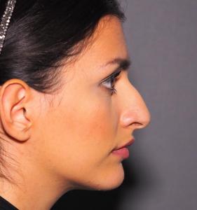 06a. Pre-op Rhinoplasty Before and After photos 01397